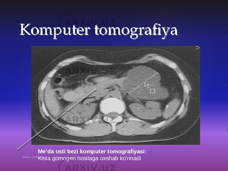 Komputer tomografiyaKomputer tomografiya Me’da osti bezi komputer tomografiyasi: Kista gomogen hosilaga oxshab ko’rinadi 