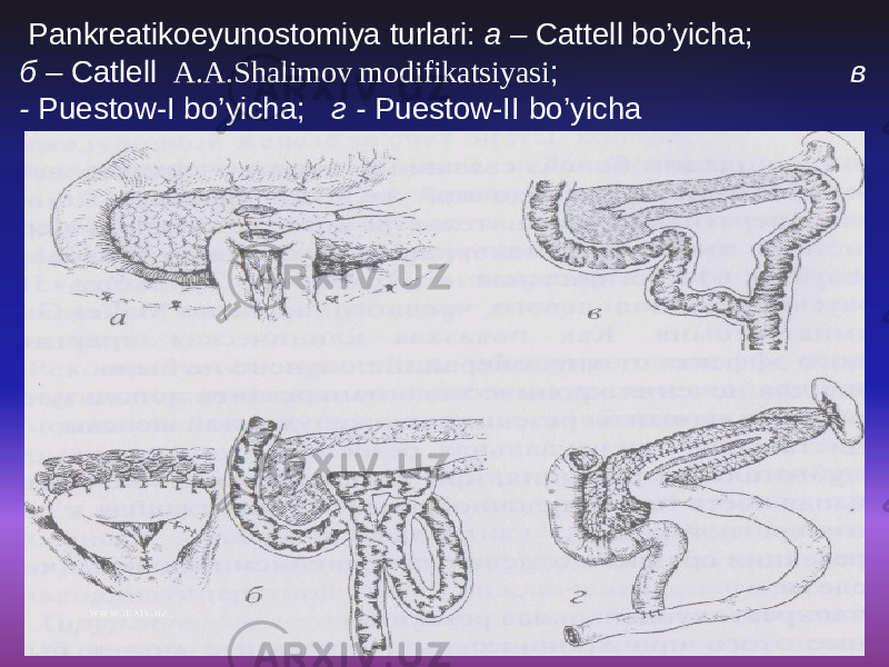  Pankreatikoeyunostomiya turlari : а – Cattell bo’yicha ; б – Catlell А .A.Shalimov modifikatsiyasi ; в - Puestow - I bo’yicha ; г - Puestow - II bo’yicha 