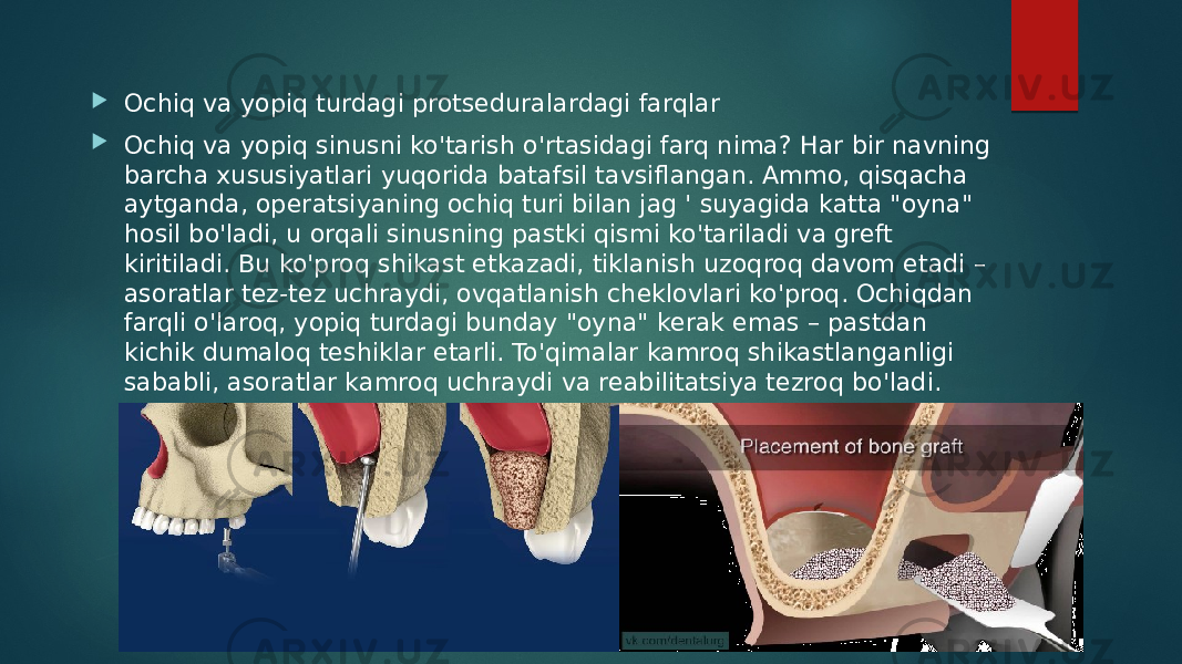  Ochiq va yopiq turdagi protseduralardagi farqlar  Ochiq va yopiq sinusni ko&#39;tarish o&#39;rtasidagi farq nima? Har bir navning barcha xususiyatlari yuqorida batafsil tavsiflangan. Ammo, qisqacha aytganda, operatsiyaning ochiq turi bilan jag &#39; suyagida katta &#34;oyna&#34; hosil bo&#39;ladi, u orqali sinusning pastki qismi ko&#39;tariladi va greft kiritiladi. Bu ko&#39;proq shikast etkazadi, tiklanish uzoqroq davom etadi – asoratlar tez-tez uchraydi, ovqatlanish cheklovlari ko&#39;proq. Ochiqdan farqli o&#39;laroq, yopiq turdagi bunday &#34;oyna&#34; kerak emas – pastdan kichik dumaloq teshiklar etarli. To&#39;qimalar kamroq shikastlanganligi sababli, asoratlar kamroq uchraydi va reabilitatsiya tezroq bo&#39;ladi. 