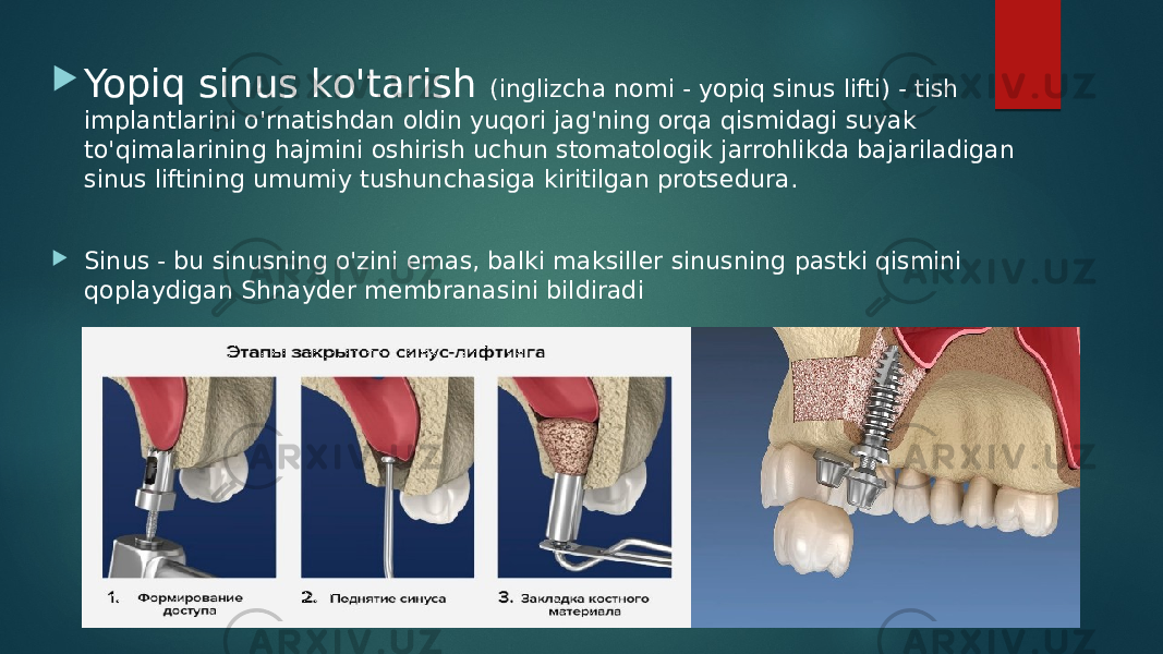  Yopiq sinus ko&#39;tarish (inglizcha nomi - yopiq sinus lifti) - tish implantlarini o&#39;rnatishdan oldin yuqori jag&#39;ning orqa qismidagi suyak to&#39;qimalarining hajmini oshirish uchun stomatologik jarrohlikda bajariladigan sinus liftining umumiy tushunchasiga kiritilgan protsedura.  Sinus - bu sinusning o&#39;zini emas, balki maksiller sinusning pastki qismini qoplaydigan Shnayder membranasini bildiradi 