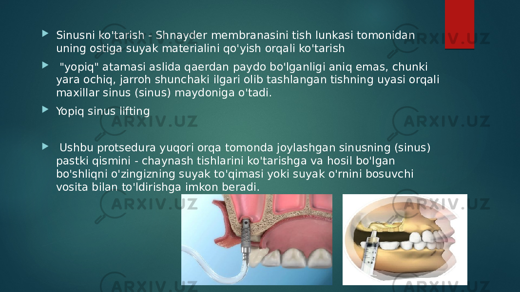  Sinusni ko&#39;tarish - Shnayder membranasini tish lunkasi tomonidan uning ostiga suyak materialini qo&#39;yish orqali ko&#39;tarish  &#34;yopiq&#34; atamasi aslida qaerdan paydo bo&#39;lganligi aniq emas, chunki yara ochiq, jarroh shunchaki ilgari olib tashlangan tishning uyasi orqali maxillar sinus (sinus) maydoniga o&#39;tadi.  Yopiq sinus lifting  Ushbu protsedura yuqori orqa tomonda joylashgan sinusning (sinus) pastki qismini - chaynash tishlarini ko&#39;tarishga va hosil bo&#39;lgan bo&#39;shliqni o&#39;zingizning suyak to&#39;qimasi yoki suyak o&#39;rnini bosuvchi vosita bilan to&#39;ldirishga imkon beradi. 