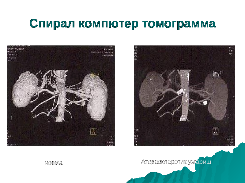 Спирал компютер томограмма норма Атеросклеротик узгариш 