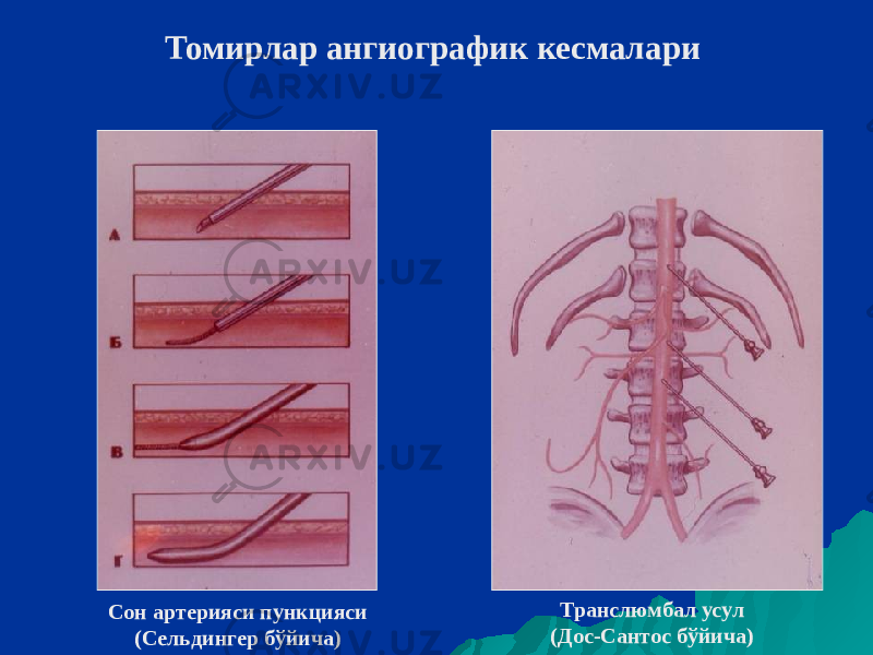 Томирлар ангиографик кесмалари Сон артерияси пункцияси (Сельдингер бўйича) Транслюмбал усул (Дос-Сантос бўйича) 
