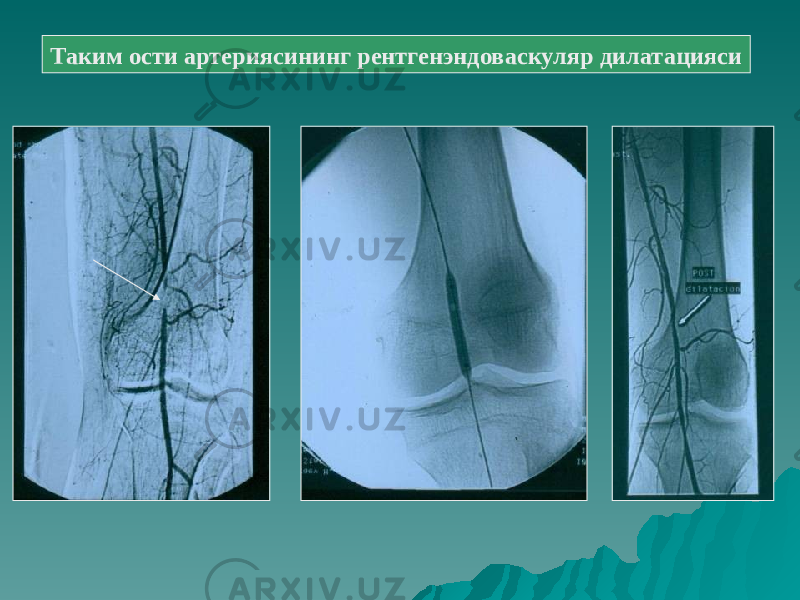 Таким ости артериясининг рентгенэндоваскуляр дилатацияси 
