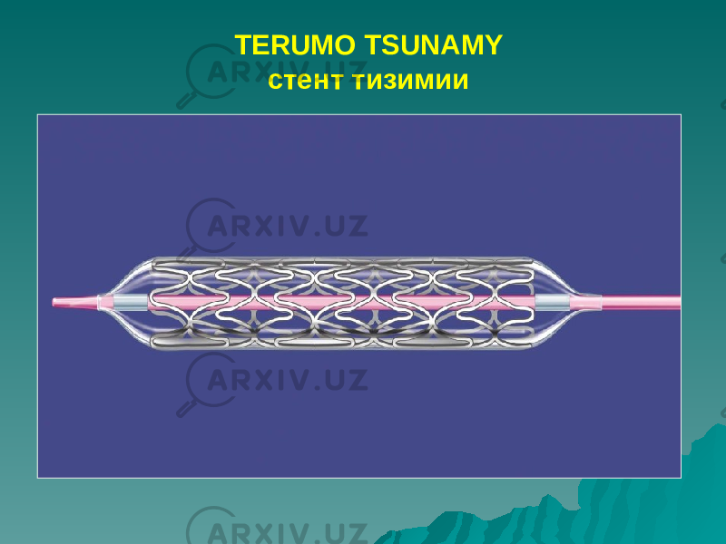 TERUMO TSUNAMY стент тизимии 