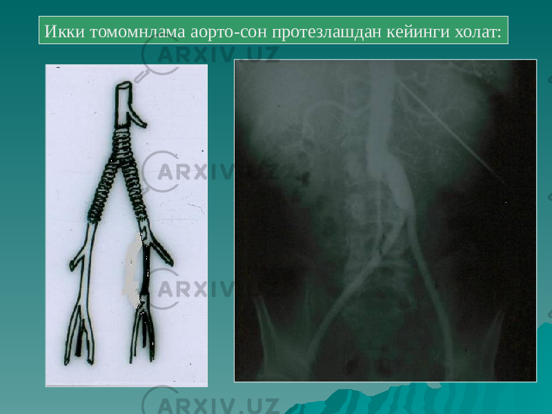 Икки томомнлама аорто-сон протезлашдан кейинги холат: 