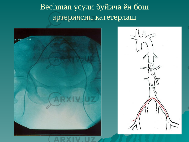 Bechman усули буйича ён бош артериясни катетерлаш 