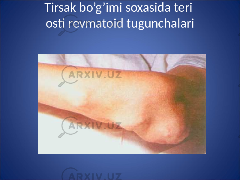 Tirsak bo’g’imi soxasida teri osti revmatoid tugunchalari 