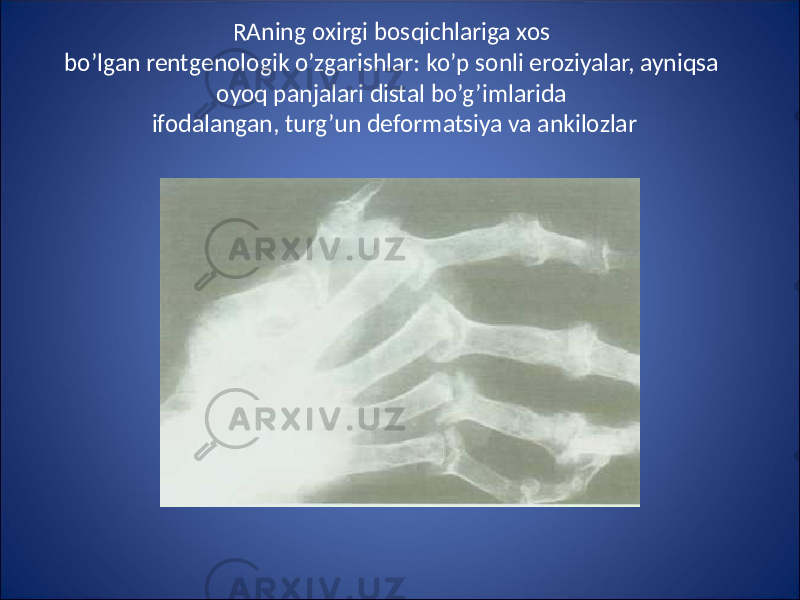 RAning oxirgi bosqichlariga xos bo’lgan rentgenologik o’zgarishlar: ko’p sonli eroziyalar, ayniqsa oyoq panjalari distal bo’g’imlarida ifodalangan, turg’un deformatsiya va ankilozlar 