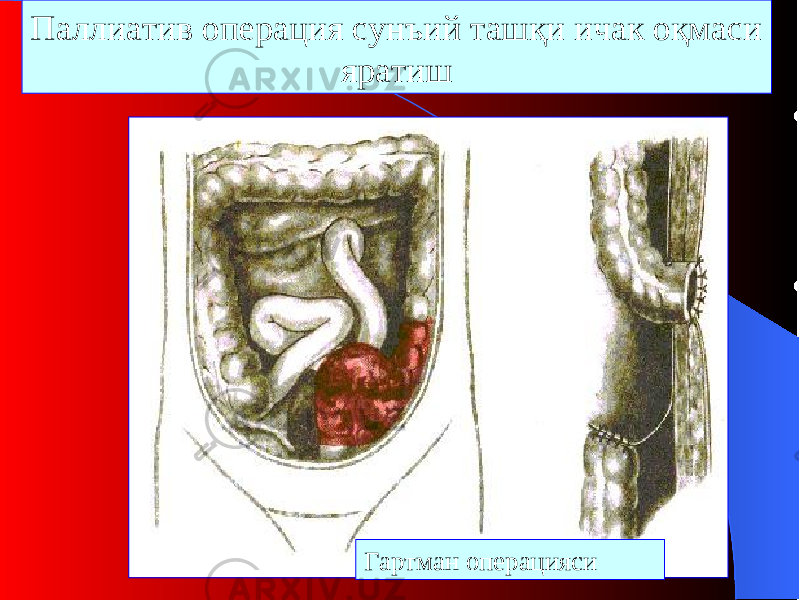 П аллиатив операция сунъий ташқи ичак оқмаси яратиш Гартман операцияси 