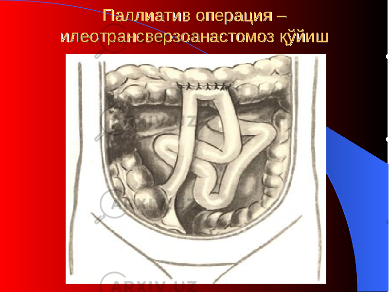 Паллиатив операция –Паллиатив операция – илеотрансверзоанастомозилеотрансверзоанастомоз қўйиш қўйиш 