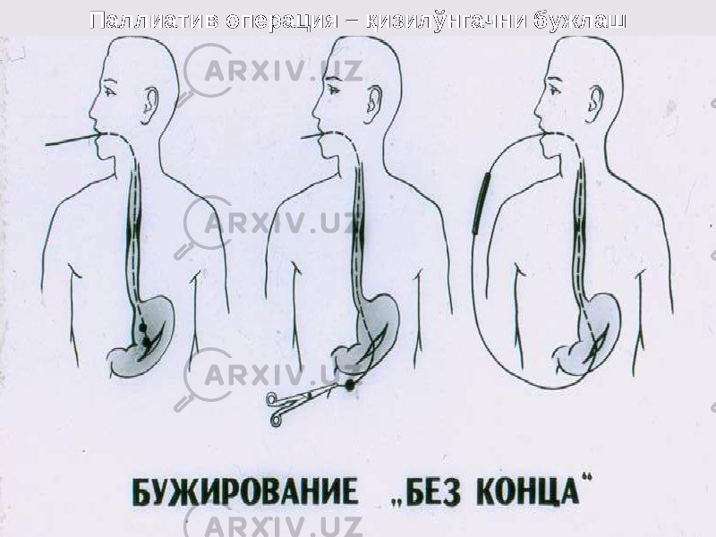 Паллиатив операция – қ изил ў нгачни бужлаш 