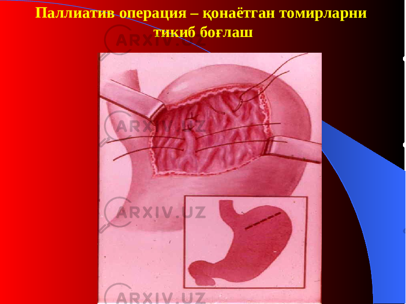 Паллиатив операция – қ онаётган томирларни тикиб бо ғ лаш 