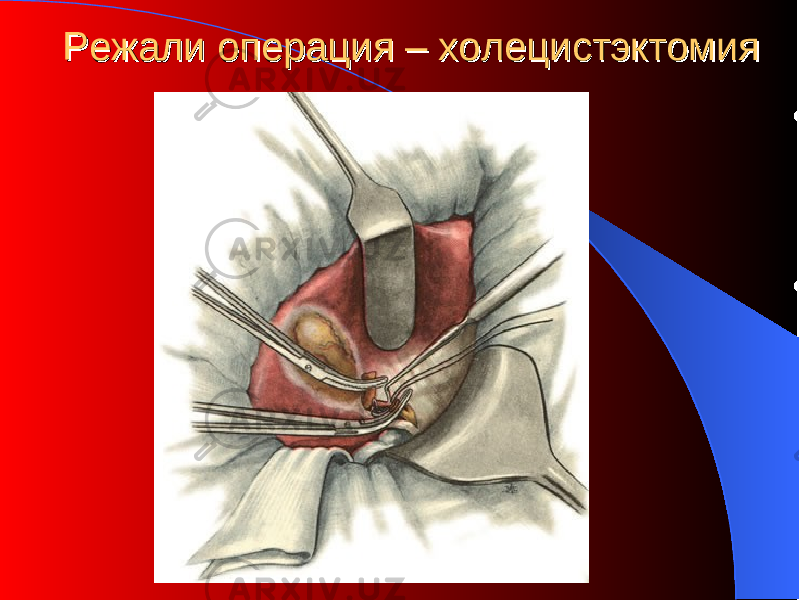 РежалиРежали операция – холецистэктомия операция – холецистэктомия 