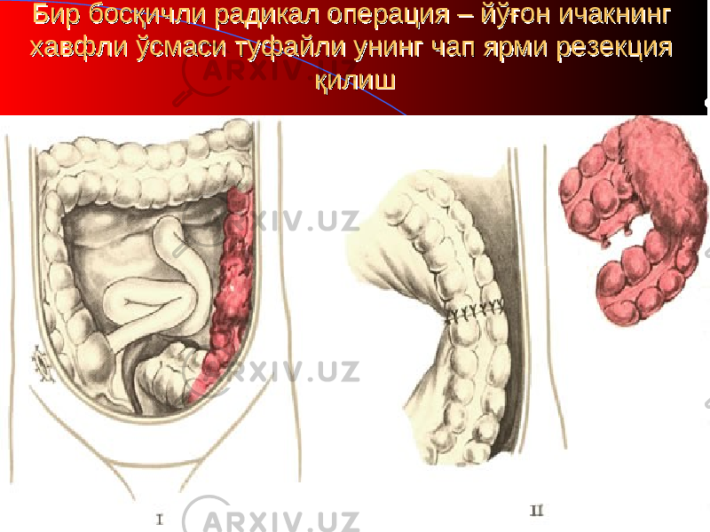 Бир босқичли радикал операция Бир босқичли радикал операция – – йўғон ичакнинг йўғон ичакнинг хавфли ўсмаси туфайли унинг чап ярми хавфли ўсмаси туфайли унинг чап ярми резекция резекция қилишқилиш 