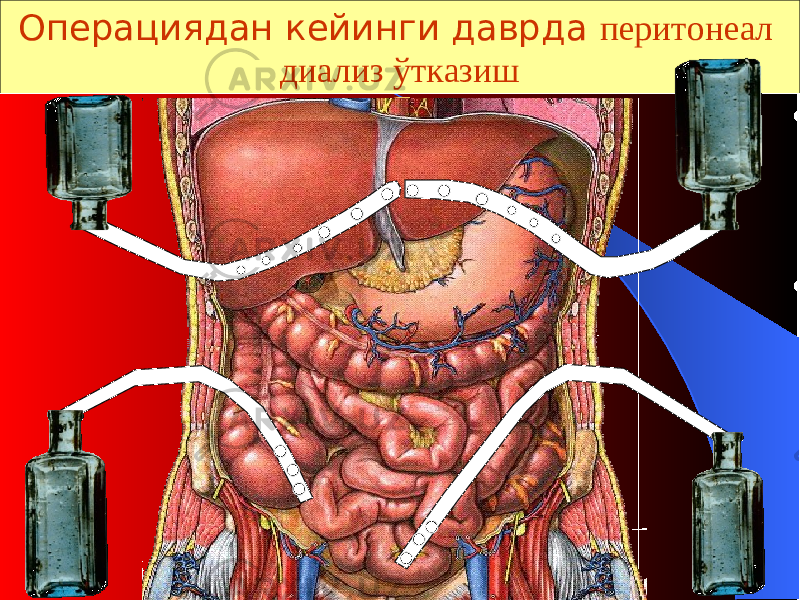 яяОперациядан кейинги даврда перитонеал диализ ўтказиш 