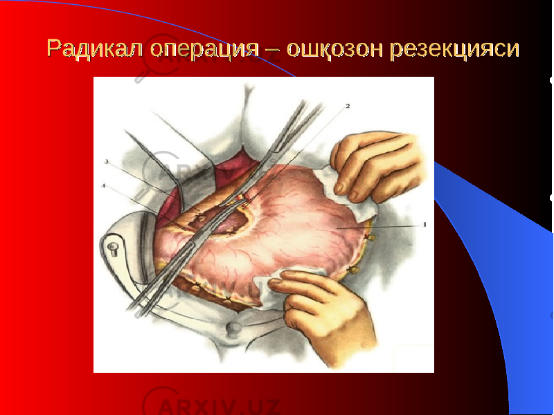 Радикал операция – Радикал операция – ошқозон ошқозон резекциярезекция сиси 