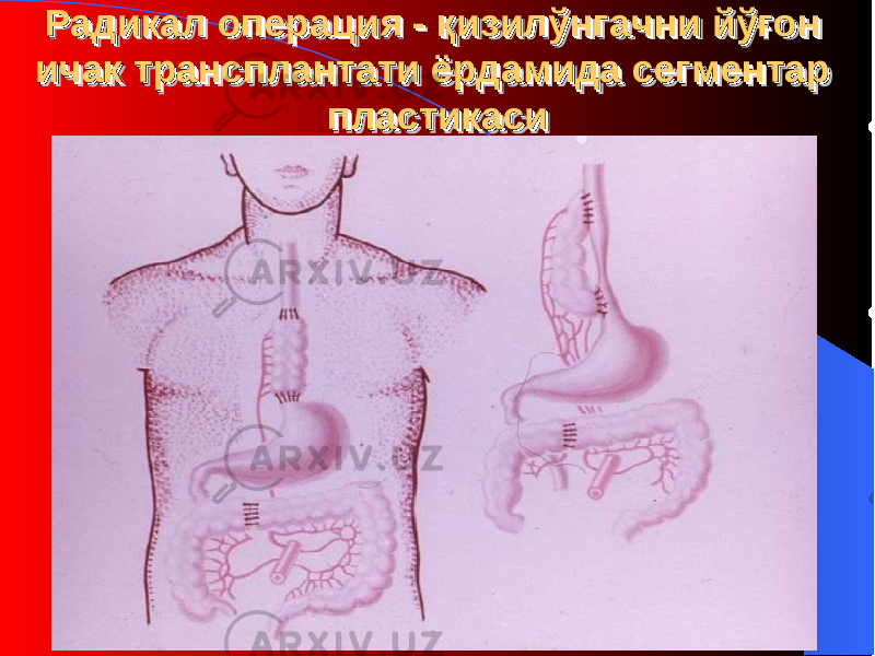 Радикал операция - Радикал операция - қизилўнгачқизилўнгач нини йй ўғон ўғон ичак ичак трансплантати трансплантати ёрдамида сегментар ёрдамида сегментар пластикасипластикасиРадикал операция - Радикал операция - қизилўнгачқизилўнгач нини йй ўғон ўғон ичак ичак трансплантати трансплантати ёрдамида сегментар ёрдамида сегментар пластикасипластикаси 