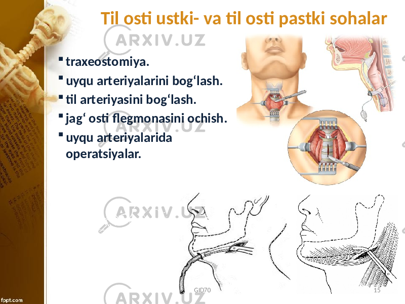 Til osti ustki- va til osti pastki sohalar  traхеоstоmiya.  uyqu artеriyalarini bоg‘lash.  til artеriyasini bоg‘lash.  jag‘ оsti flеgmоnasini оchish.  uyqu artеriyalarida оpеratsiyalar. GID70 15 