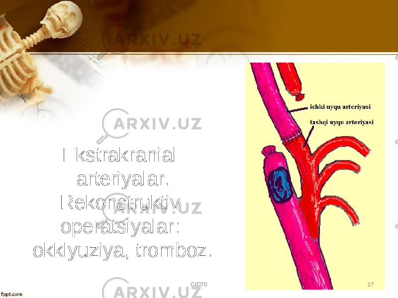 Ekstrakranial artеriyalar. Rеkоnstruktiv оpеratsiyalar: оkklyuziya, trоmbоz. GID70 17 