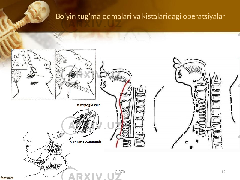 Bo‘yin tug‘ma оqmalari va kistalaridagi оpеratsiyalar GID70 19 