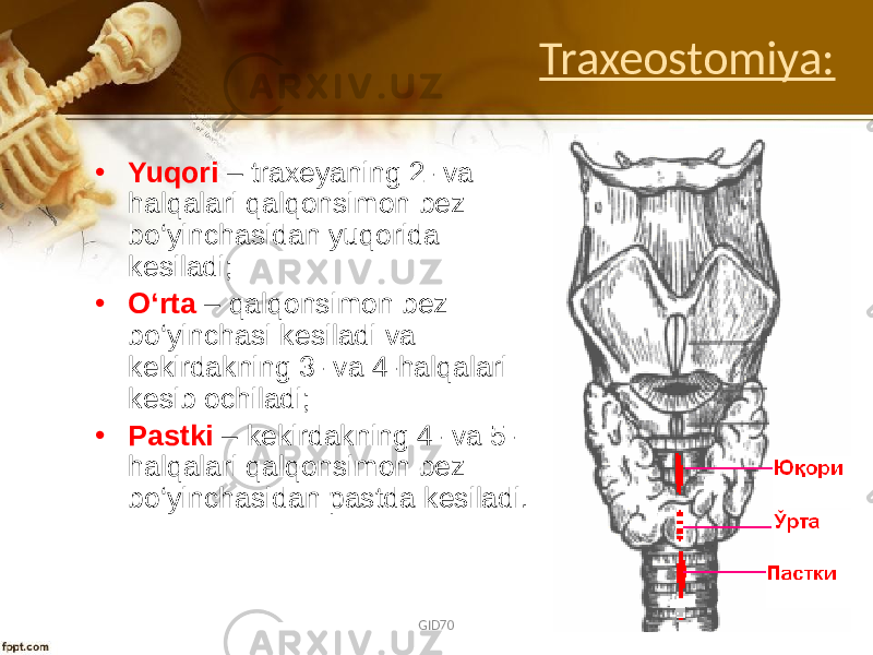 Traxeostomiya: • Yuqоri – traхеyaning 2- va halqalari qalqоnsimоn bеz bo‘yinchasidan yuqоrida kеsiladi; • O‘rta – qalqоnsimоn bеz bo‘yinchasi kеsiladi va kеkirdakning 3- va 4-halqalari kеsib оchiladi; • Pastki – kеkirdakning 4- va 5- halqalari qalqоnsimоn bеz bo‘yinchasidan pastda kеsiladi. GID70 22 