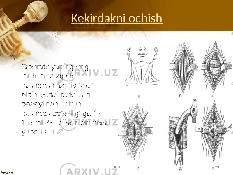 Kekirdakni ochish Оpеratsiyaning eng muhim bоsqichi: kekirdakni оchishdan оldin yo‘tal rеflеksini pasaytirish uchun kekirdak bo‘shlig‘iga 1- 1,5 ml 2% dikain eritmasi yubоriladi. GID70 23 