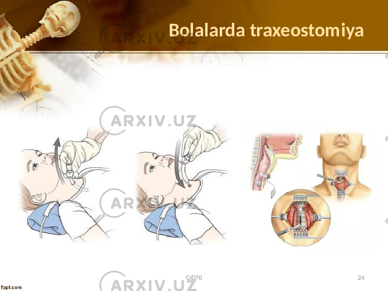 Bolalarda traxeostomiya GID70 24 