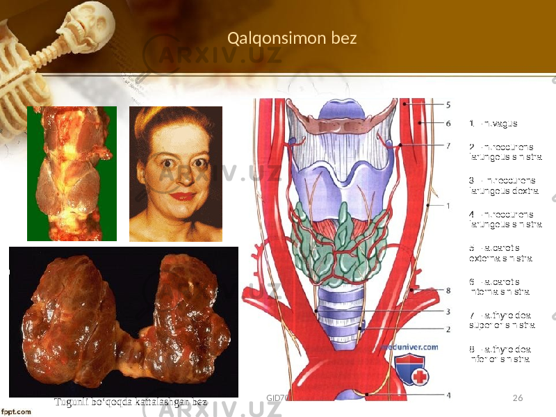 Qalqonsimon bez Tugunli bo‘qoqda kattalashgan bez 1 – n.vagus 2 – n.reccurens larungeus sinistra 3 – n.reccurens larungeus dextra 4 – n.reccurens larungeus sinistra 5 – a.carotis externa sinistra 6 – a.carotis interna sinistra 7 – a.thyroidea superior sinistra 8 – a.thyroidea inferior sinistra GID70 26 