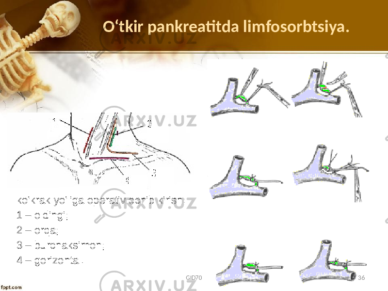 O ʻtkir pankreatitda limfosorbtsiya. ko‘krak yo‘liga оpеrativ оchib kirish: 1 – оldingi; 2 – оrqa; 3 – burchaksimоn; 4 – gоrizоntal. GID70 36 