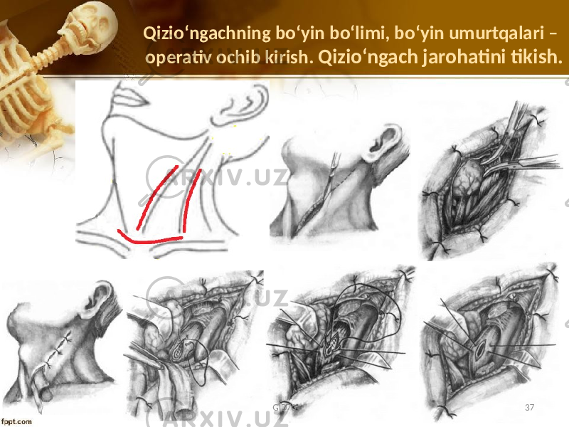 Qizio ʻngachning boʻyin boʻlimi, boʻyin umurtqalari – operativ ochib kirish. Qizioʻngach jarohatini tikish. GID70 37 