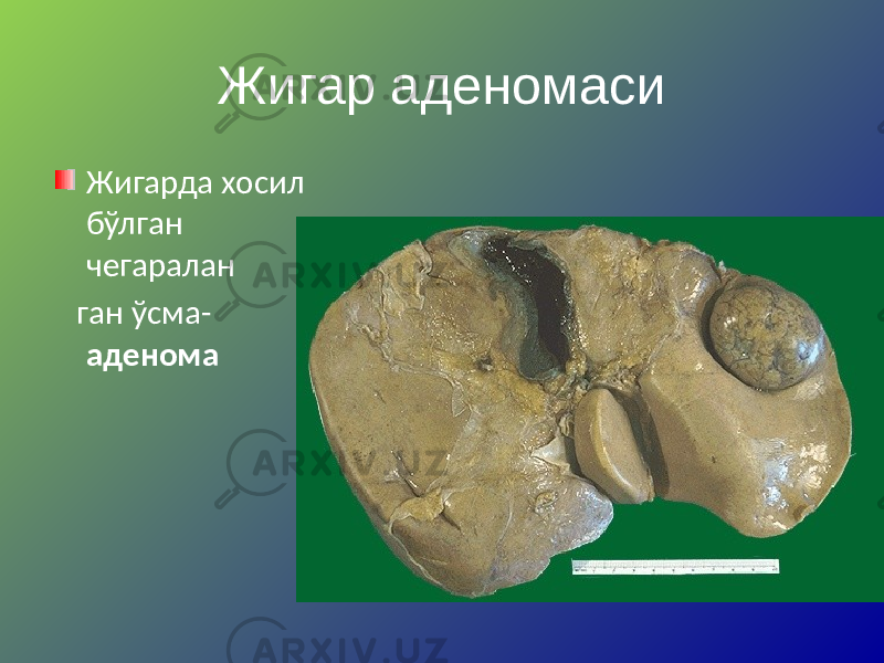 Жигар аденомаси Жигарда хосил бўлган чегаралан ган ўсма- аденома 