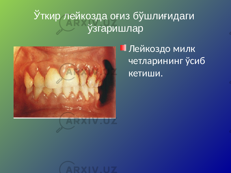 Ўткир лейкозда оғиз бўшлиғидаги ўзгаришлар Лейкоздо милк четларининг ўсиб кетиши. 