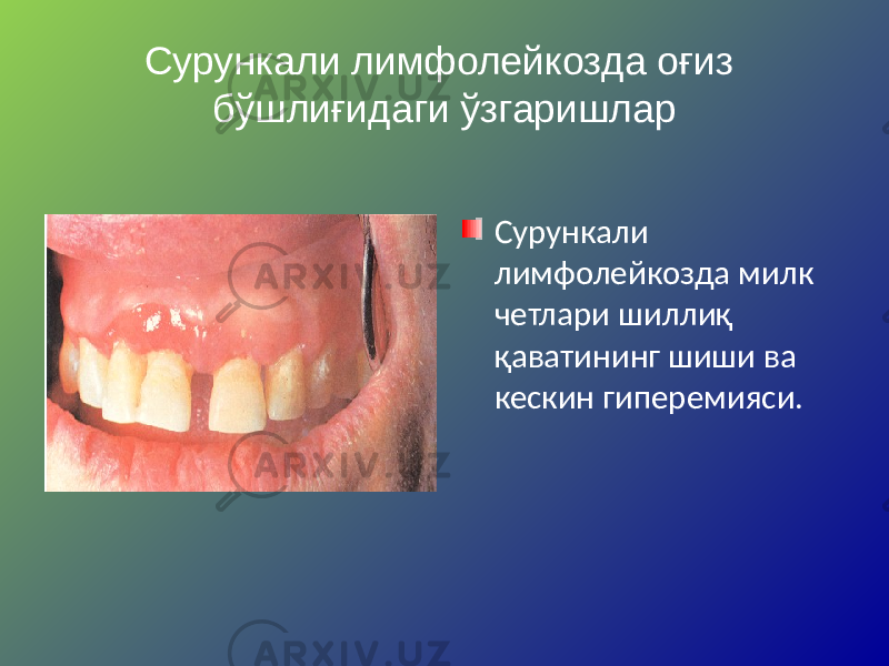 Сурункали лимфолейкозда оғиз бўшлиғидаги ўзгаришлар Сурункали лимфолейкозда милк четлари шиллиқ қаватининг шиши ва кескин гиперемияси. 