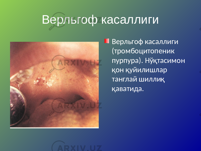 Верльгоф касаллиги Верльгоф касаллиги (тромбоцитопеник пурпура). Нўқтасимон қон қуйилишлар танглай шиллиқ қаватида. 