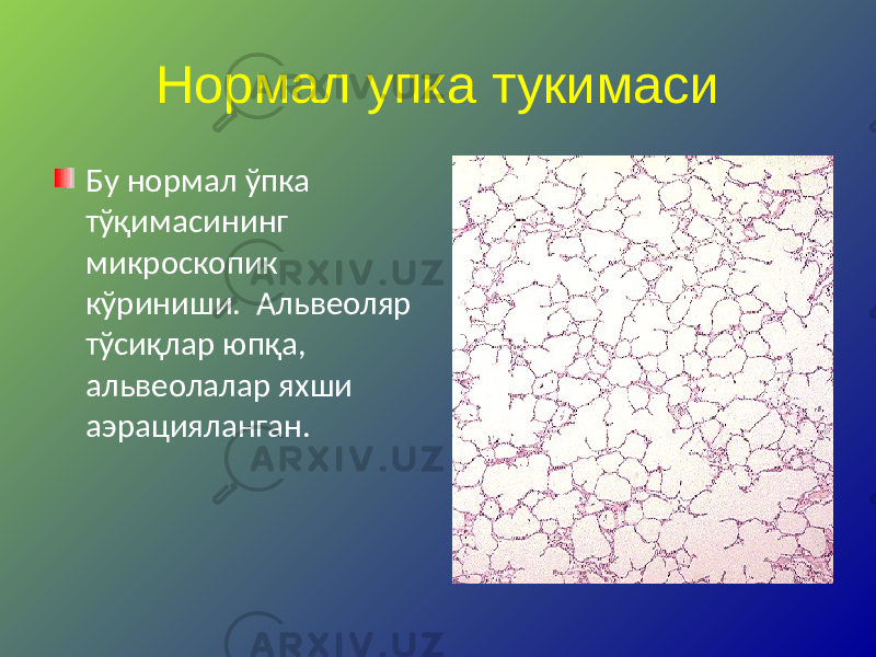 Нормал упка тукимаси Бу нормал ўпка тўқимасининг микроскопик кўриниши. Альвеоляр тўсиқлар юпқа, альвеолалар яхши аэрацияланган. 