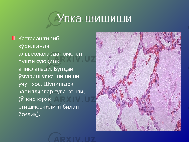 Упка шишиши Катталаштириб кўрилганда альвеолаларда гомоген пушти суюқлик аниқланади. Бундай ўзгариш ўпка шишиши учун хос. Шунингдек капиллярлар тўла қонли. (Ўткир юрак етишмовчилиги билан боғлиқ). 