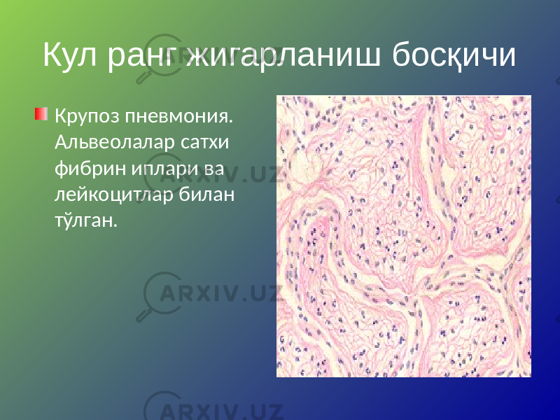 Кул ранг жигарланиш босқичи Крупоз пневмония. Альвеолалар сатхи фибрин иплари ва лейкоцитлар билан тўлган. 