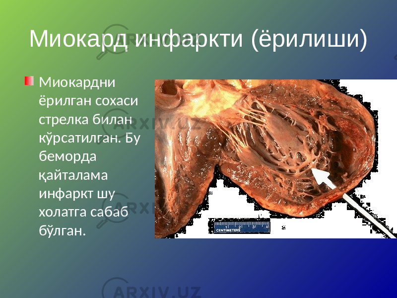 Миокард инфаркти (ёрилиши) Миокардни ёрилган сохаси стрелка билан кўрсатилган. Бу беморда қайталама инфаркт шу холатга сабаб бўлган. 