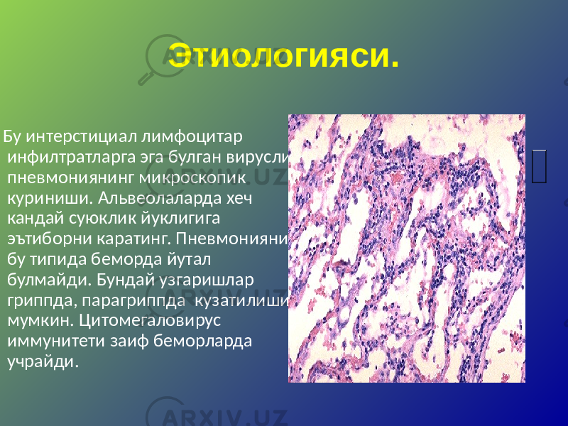 Этиологияси. Бу интерстициал лимфоцитар инфилтратларга эга булган вирусли пневмониянинг микроскопик куриниши. Альвеолаларда хеч кандай суюклик йуклигига эътиборни каратинг. Пневмонияни бу типида беморда йутал булмайди. Бундай узгаришлар гриппда, парагриппда кузатилиши мумкин. Цитомегаловирус иммунитети заиф беморларда учрайди. 