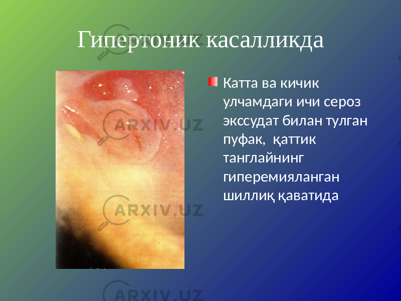 Гипертоник касалликда Катта ва кичик улчамдаги ичи сероз экссудат билан тулган пуфак, қаттик танглайнинг гиперемияланган шиллиқ қаватида 