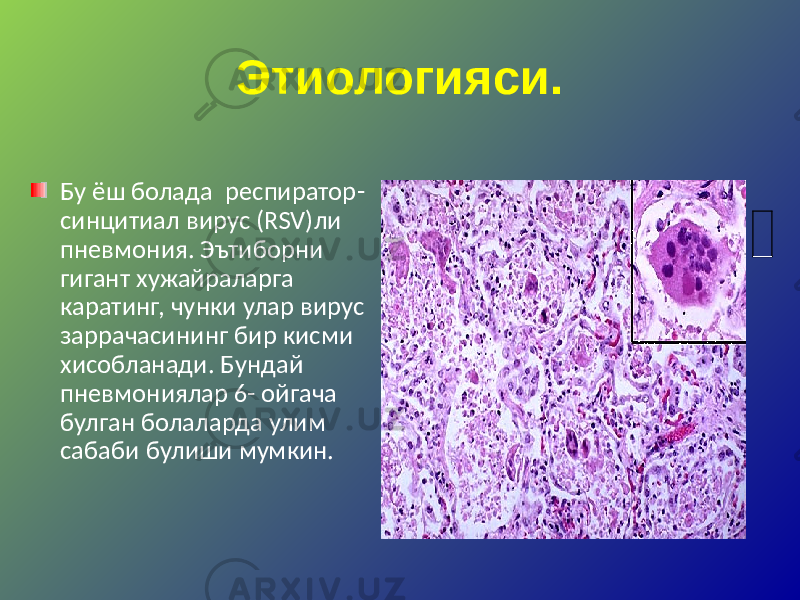 Этиологияси. Бу ёш болада респиратор- синцитиал вирус (RSV)ли пневмония. Эътиборни гигант хужайраларга каратинг, чунки улар вирус заррачасининг бир кисми хисобланади. Бундай пневмониялар 6- ойгача булган болаларда улим сабаби булиши мумкин. 