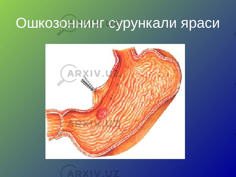 Ошкозоннинг сурункали яраси 