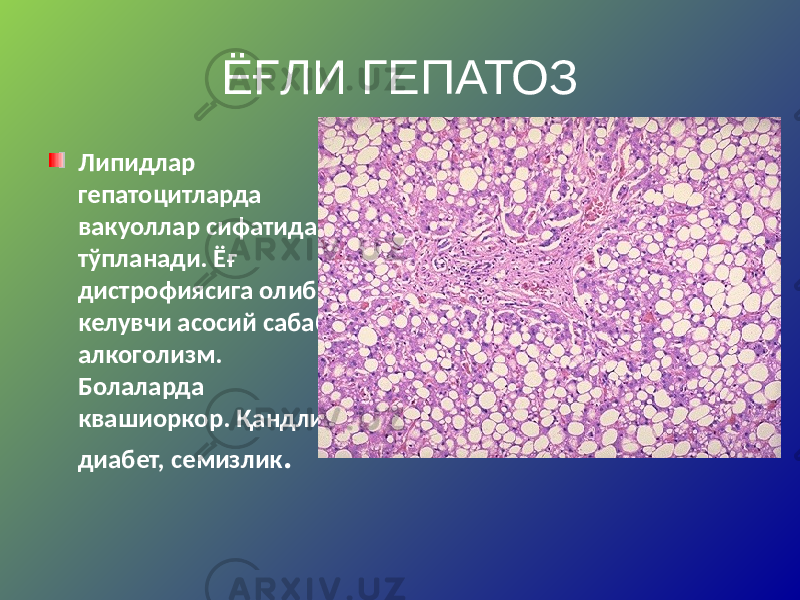 ЁҒЛИ ГЕПАТОЗ Липидлар гепатоцитларда вакуоллар сифатида тўпланади. Ёғ дистрофиясига олиб келувчи асосий сабаб – алкоголизм. Болаларда квашиоркор. Қандли диабет, семизлик . 