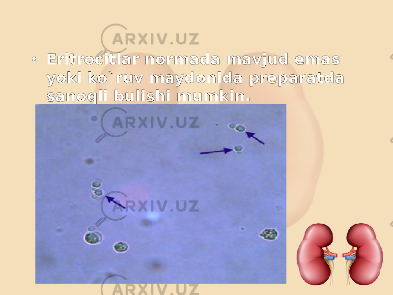 • Eritrocitlar normada mavjud emas yoki ko`ruv maydonida preparatda sanoqli bulishi mumkin. 