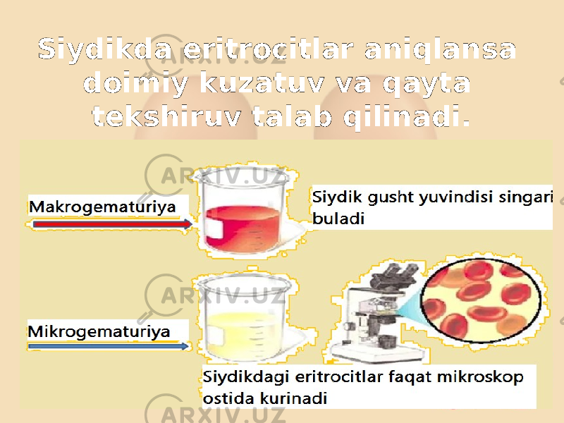 Siydikda eritrocitlar aniqlansa doimiy kuzatuv va qayta tekshiruv talab qilinadi. 