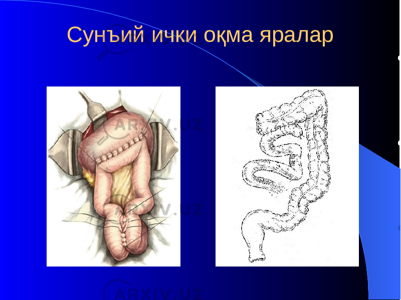 Сунъий ички оқма яралар 