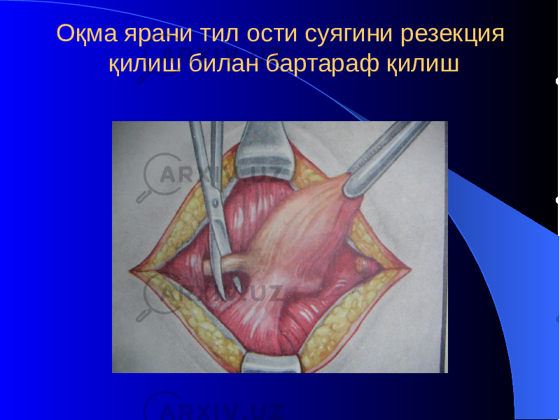 Оқма ярани тил ости суягини резекция қилиш билан бартараф қилиш 