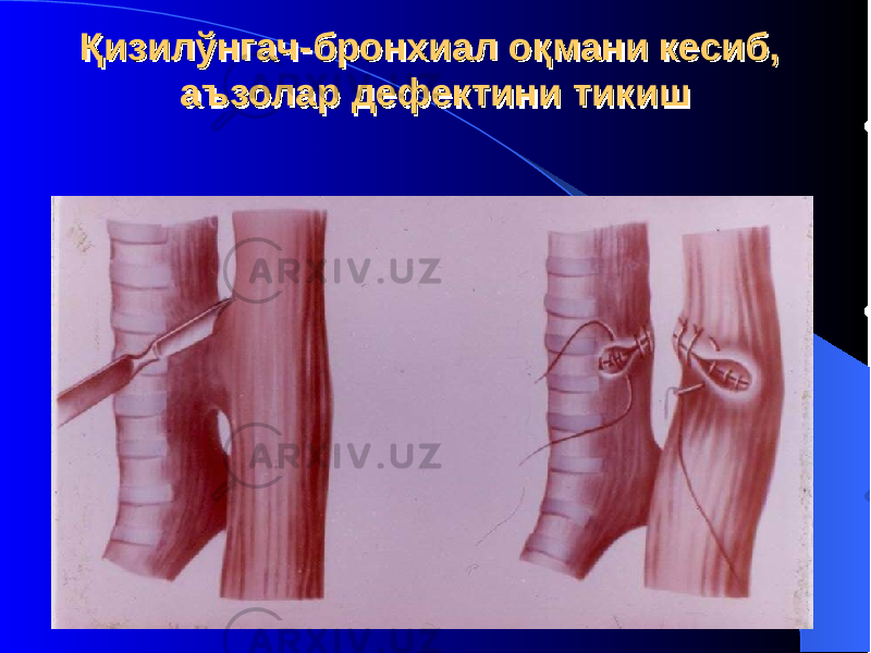 Қизилўнгач-бронхиал оқмани кесиб, аъзолар дефектини тикишҚизилўнгач-бронхиал оқмани кесиб, аъзолар дефектини тикиш 