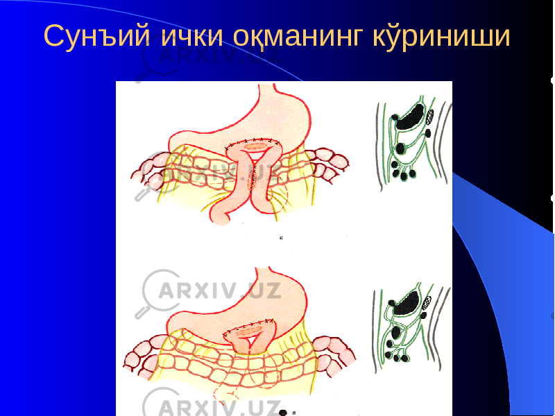 Сунъий ички оқманинг кўриниши 